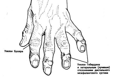 Костные наросты на суставах пальцев рук. Узелок Бушара на указательном пальце. Узелки Гебердена на безымянном пальце и мизинце. Развернутая стадия остеоартртита (артроза) суставов пальцев рук