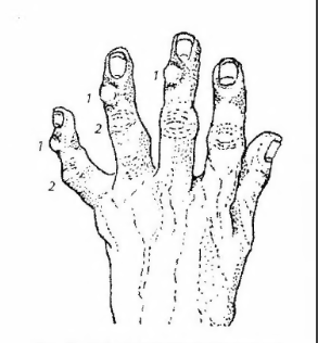 Вузлики Гебердена (позначені цифрою 1) та вузлики Бушара (позначені цифрою 2) нарости на суглобах пальців рук. Розгорнута стадія остеоартриту (артрозу) пальців рук