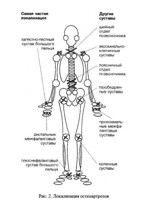 Поражение суставов при остеоартрозе (остеоартрите): суставы фалангов пальцев (узелки Бушара и Гебердена), тазобедренные и коленные суставы, запястно-пястный сустав большого пальца, акромиально-ключичные, суставы шейного и поясничного отделов позвоночника, плюснефаланговый сустав большого пальца.