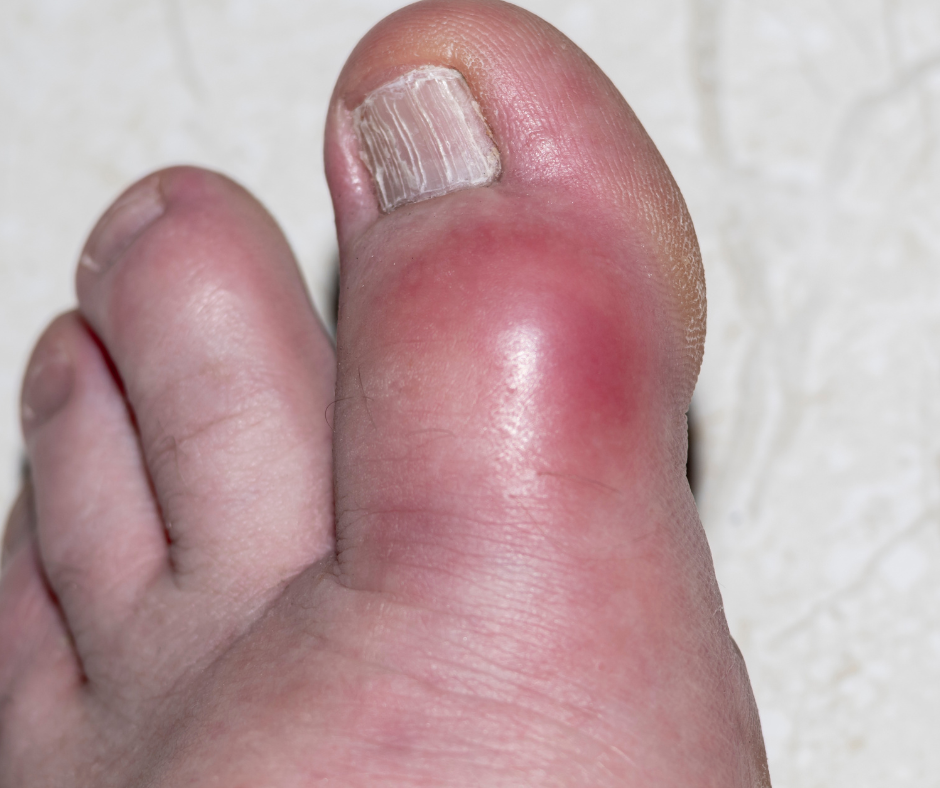 Подагра большого пальца ноги фото. Симптомы подагрического артрита: выраженная припухлость, покраснение кожи над пораженным суставом.