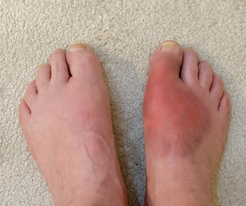 Подагрический артрит фото. Подагра на большом пальце ноги. Симптомы подагры: обширный очаг воспаления с покраснением кожи.